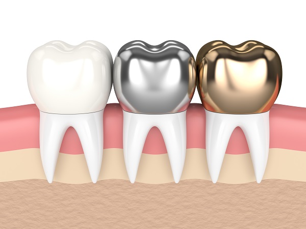 What Your Dentist Wants You To Know About Natural Looking Dental Crowns